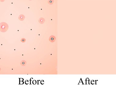Doku, iltihaplı sivilce ve sivilceler. Sivilceden önce. Deri arkaplanı. Bilgi grafikleri. İzole edilmiş arkaplanda vektör illüstrasyonu