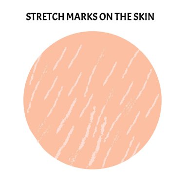 Deride gerilme izleri var. Deride gerilme izleri var. Bilgi grafikleri. Vektör illüstrasyonu