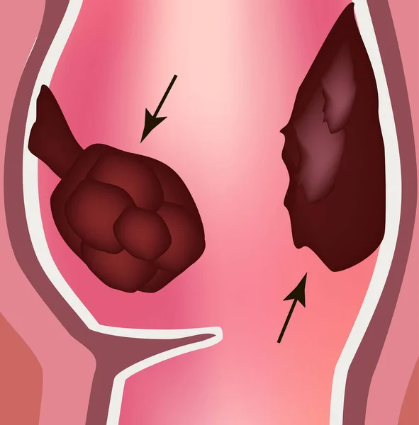 Pólipos en el recto. Estructura del recto del intestino. Tipos de pólipos en el colon. Infografías. Ilustración vectorial sobre fondo aislado . — Vector de stock