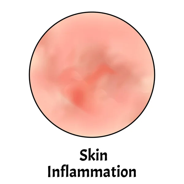 Воспаление кожи. Кожа от дерматита. Инфографика. Векторная иллюстрация на изолированном фоне . — стоковый вектор