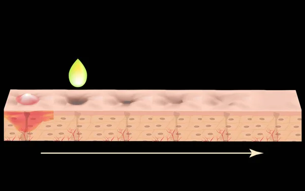 Cicatrici atrofiche. Cicatrice d'acne. La struttura anatomica della pelle con acne. Illustrazione vettoriale. — Vettoriale Stock