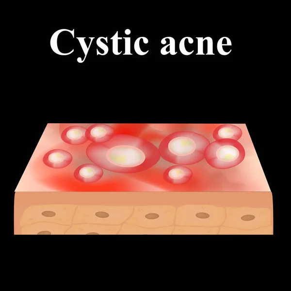 Cyst acne. Acne on the skin of a cyst. Dermatological and cosmetic diseases on the skin of the face. Infographics. Vector illustration on isolated background. — Stock Vector