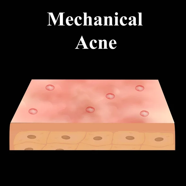 Cyste acne. Acne op de huid van een cyste. Dermatologische en cosmetische ziekten op de huid van het gezicht. Infografieën. Vectorillustratie op geïsoleerde achtergrond. — Stockvector