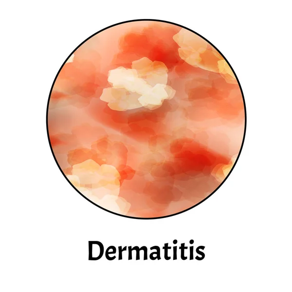 Inflamación cutánea. Dermatitis cutánea. Infografías. Ilustración vectorial sobre fondo aislado . — Vector de stock