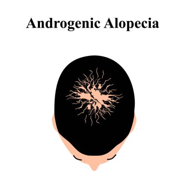 Alopecia saçı. Kafasındaki kıllar dökülmüş. Androjenik alopecia. Bilgi grafikleri. İzole edilmiş arkaplanda vektör illüstrasyonu.