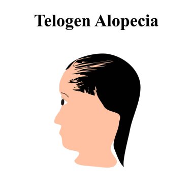 Alopecia saçı. Kafasındaki kıllar dökülmüş. Telojen Alopecia. Bilgi grafikleri. İzole edilmiş arkaplanda vektör illüstrasyonu.
