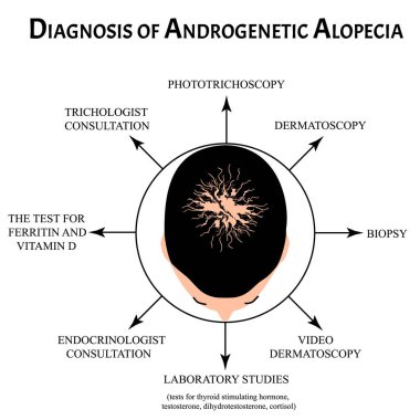 Alopezi teşhisi. Kel nokta, kellik, Alopecia mezoterapisi. Bilgi grafikleri. İzole edilmiş arkaplanda vektör illüstrasyonu.