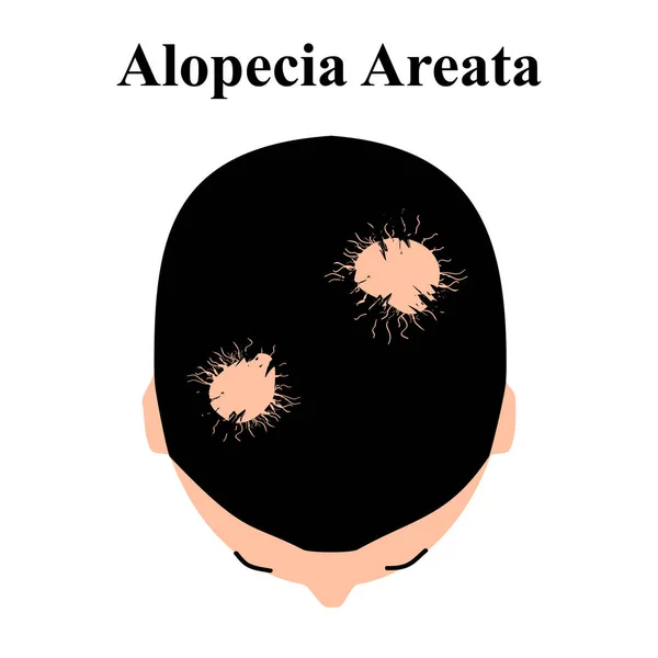 Alopécia haj. Kopaszság a fejen. Alopecia areata. Infografikák. Vektorillusztráció izolált háttérrel. — Stock Vector