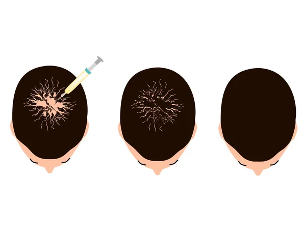 Alopécia kezelése. Kopasz folt, kopaszság, alopecia mezoterápia. Infografikák. Vektorillusztráció izolált háttérrel. — Stock Vector