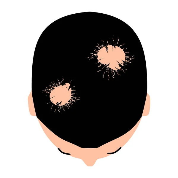 Alopecia haar. Kaalheid van haar op het hoofd. Alopecia areata. Infografieën. Vectorillustratie op geïsoleerde achtergrond. — Stockvector