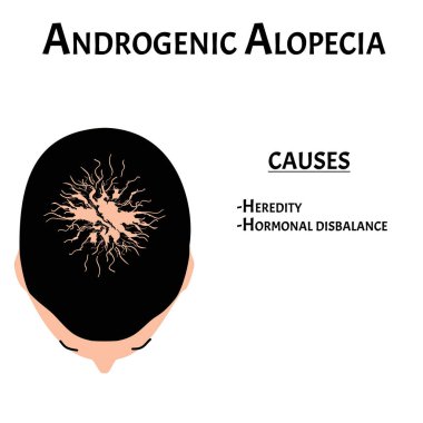 Alopecia saçı. Kafasındaki kıllar dökülmüş. Androjenik alopezi neden olur. Bilgi grafikleri. İzole edilmiş arkaplanda vektör illüstrasyonu.