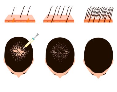 Alopecia tedavisi. Kel nokta, kellik, Alopecia mezoterapisi. Bilgi grafikleri. İzole edilmiş arkaplanda vektör illüstrasyonu.