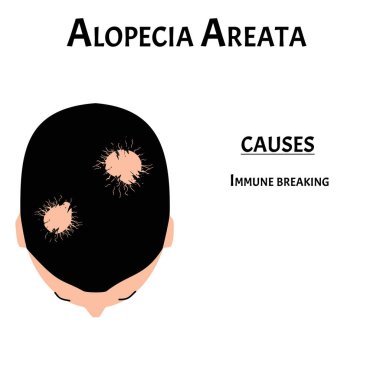 Alopecia saçı. Kafasındaki kıllar dökülmüş. Alopecia areata neden olur. Bilgi grafikleri. İzole edilmiş arkaplanda vektör illüstrasyonu.