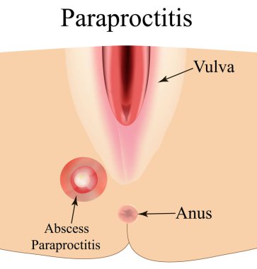 Paraproktit. Karın zarında apse var. Enflamasyon paraproktit. Bilgi grafikleri. İzole edilmiş arkaplanda vektör illüstrasyonu.