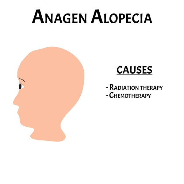 Alopecie. Plešatost vlasů na hlavě. Anagen Alopecia způsobuje. Infographics. Vektorová ilustrace na izolovaném pozadí. — Stockový vektor