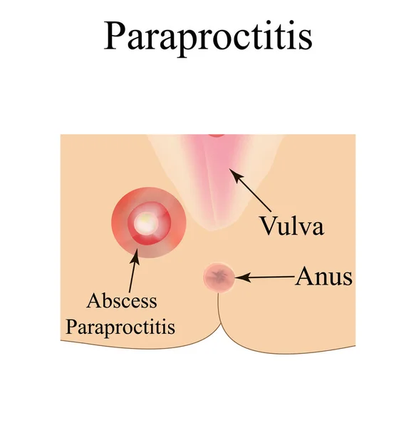 Paraproctitis. Abces in het perineum. Ontstekingsparaproctitis. Infografieën. Vectorillustratie op geïsoleerde achtergrond. — Stockvector