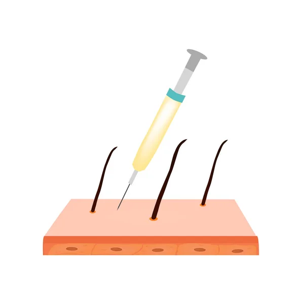 Tratamento da alopecia. Careca, calvície, alopecia mesoterapia. Infográficos. Ilustração vetorial sobre fundo isolado . — Vetor de Stock