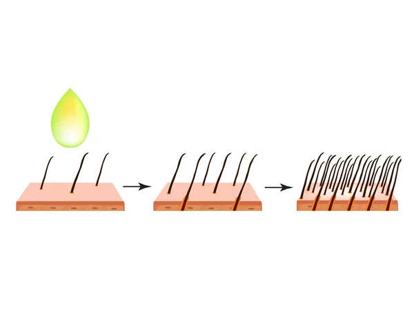 Tratamiento de la alopecia. Mancha calva, calvicie, mesoterapia con alopecia. Infografías. Ilustración vectorial sobre fondo aislado . — Vector de stock