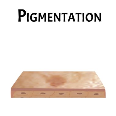 Deride pigmentasyon. Deride kahverengi lekeler var. Pigmentasyon tedavisi. Bilgi grafikleri. İzole edilmiş arkaplanda vektör illüstrasyonu.