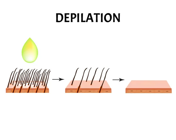 Depilazione dei capelli. Depilazione. Infografica. Illustrazione vettoriale su sfondo isolato . — Vettoriale Stock