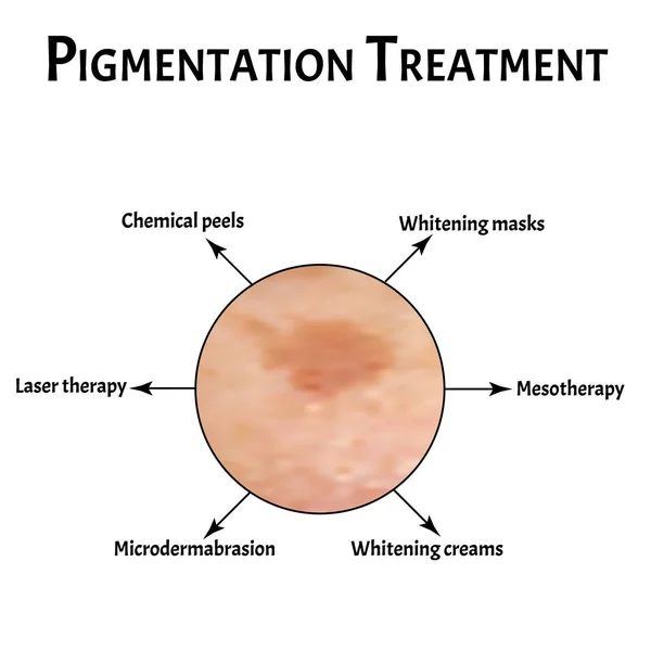 Пигментация кожи. Кожные пятна на коже. Лечение пигментации. Инфографика. Векторная иллюстрация на изолированном фоне . — стоковый вектор