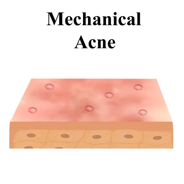 Gesloten komedies. Acne op de huid. Dermatologische en cosmetische ziekten op de huid van het gezicht acne. Infografieën. Vectorillustratie op geïsoleerde achtergrond. — Stockvector