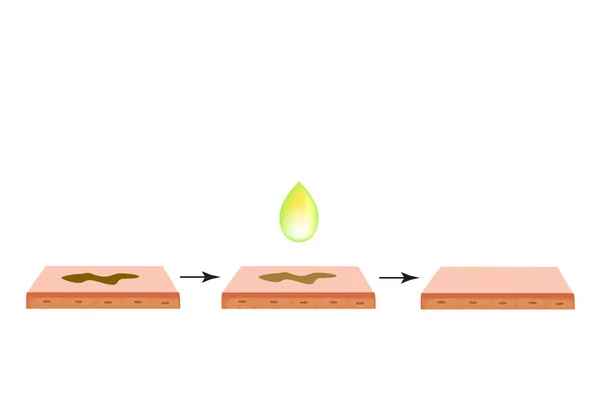 Pigmentatie op de huid. Bruine vlekken op de huid. Pigmentatiebehandeling. Infografieën. Vectorillustratie op geïsoleerde achtergrond. — Stockvector