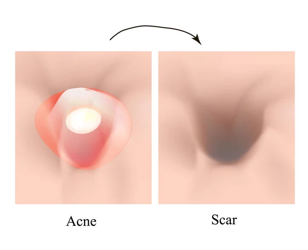 Cicatrices atróficas. Cicatriz de acné. Estructura anatómica de la piel con acné. Ilustración vectorial sobre fondo aislado . — Vector de stock