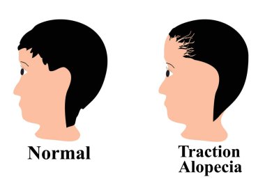 Alopecia saçı. Kafasındaki kıllar dökülmüş. Çekiş alopecisi. Bilgi grafikleri. İzole edilmiş arkaplanda vektör illüstrasyonu.