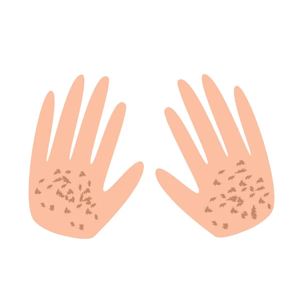 Freckles on the hands. Pigmentation on the skin. A pigmented spot on the skin of the hands. Vector illustration — Stock Vector