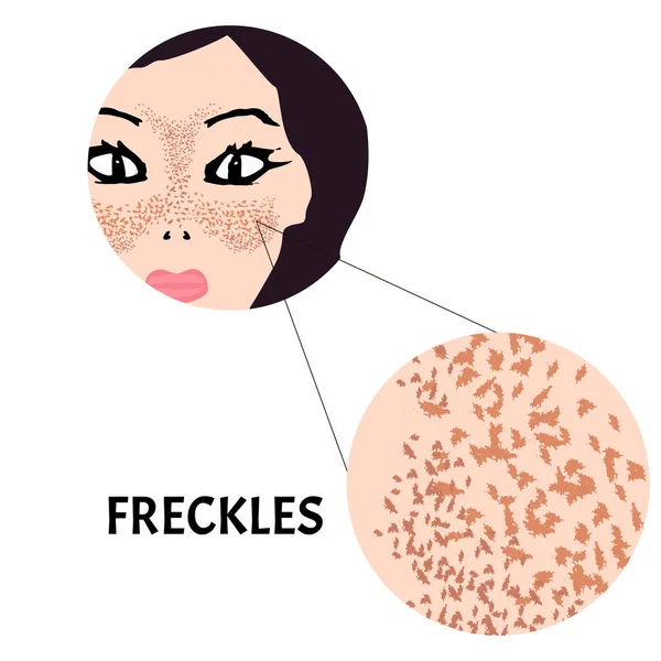 Sardas na cara. Pigmentação na pele. Uma mancha pigmentada na pele do rosto. Antes e depois do tratamento. Ilustração vetorial — Vetor de Stock