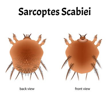 Sarcoptes Scabiei. Uyuz. Cinsel yolla bulaşan bir hastalık. Bilgi grafikleri. İzole edilmiş arkaplanda resimler.