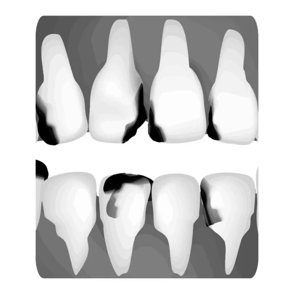 Zahnkaries. Röntgenbild von Karies. Kariesinfografiken. Vektor-Illustration auf isoliertem Hintergrund. — Stockvektor