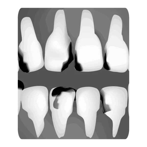 Dental caries. X-ray of tooth decay. Caries infographics. Vector illustration on isolated background. — Stock Vector
