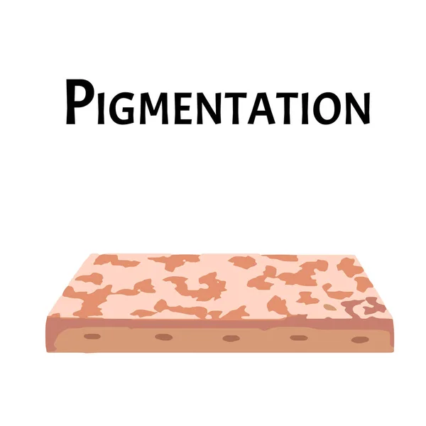 Pigmentation sur la peau. Tache pigmentée sur la peau du visage. Illustration vectorielle — Image vectorielle