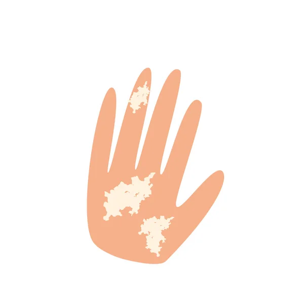 Vitiligo auf der Hand. Weiße Flecken auf der Handhaut. Infografik Vektorillustration. — Stockvektor