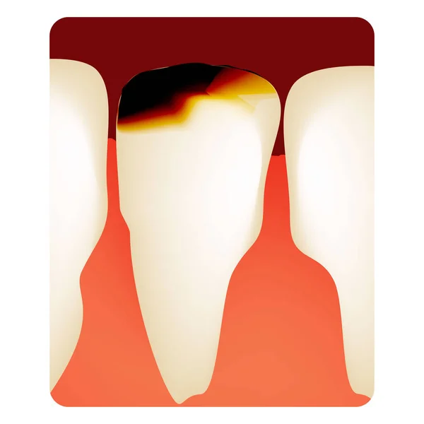 Próchnica dentystyczna. próchnica zębów. Infografika próchnicy. Ilustracja wektora na pojedynczym tle. — Wektor stockowy