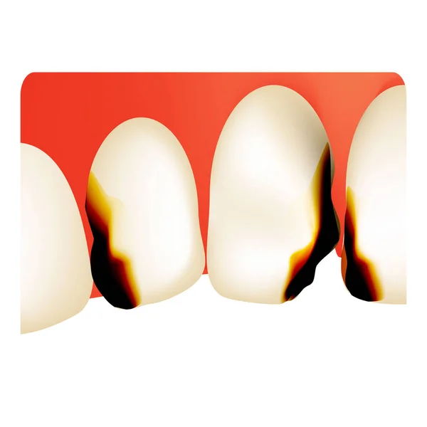 牙齿蛀牙。蛀牙。Caries的资讯图孤立背景下的矢量说明. — 图库矢量图片