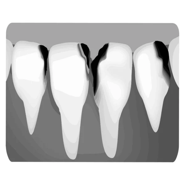 Cárie dentária. Raios-X da cárie dentária. Infográficos de cárie. Ilustração vetorial sobre fundo isolado . —  Vetores de Stock