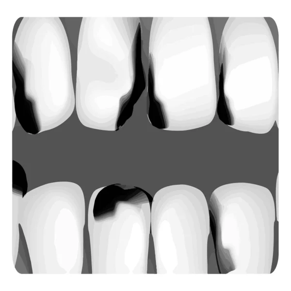 Diş bakımı. Diş çürüğünün röntgeni. Taşıyıcı bilgiler. İzole edilmiş arkaplanda vektör illüstrasyonu. — Stok Vektör