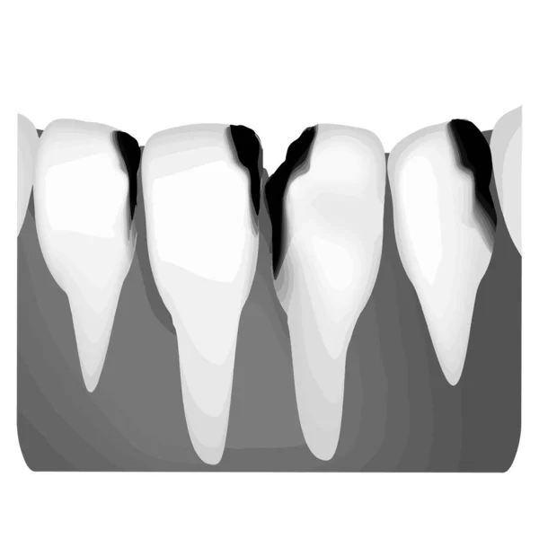 Tandcariës. X-ray van tandbederf. Caries infographics. Vectorillustratie op geïsoleerde achtergrond. — Stockvector