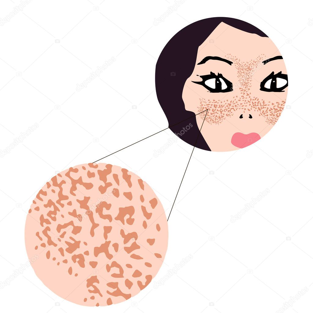 Freckles on the face. Pigmentation on the skin. A pigmented spot on the skin of the face. Vector illustration