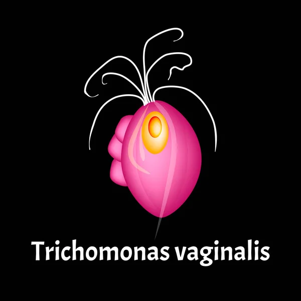 トリコモナス膣。インフォグラフィックだ。孤立した背景のベクトル図. — ストックベクタ