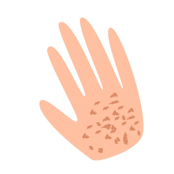 Sommersprossen auf der Hand. Pigmentierung auf der Haut. Pigmentflecken auf der Handhaut. Vektorillustration — Stockvektor
