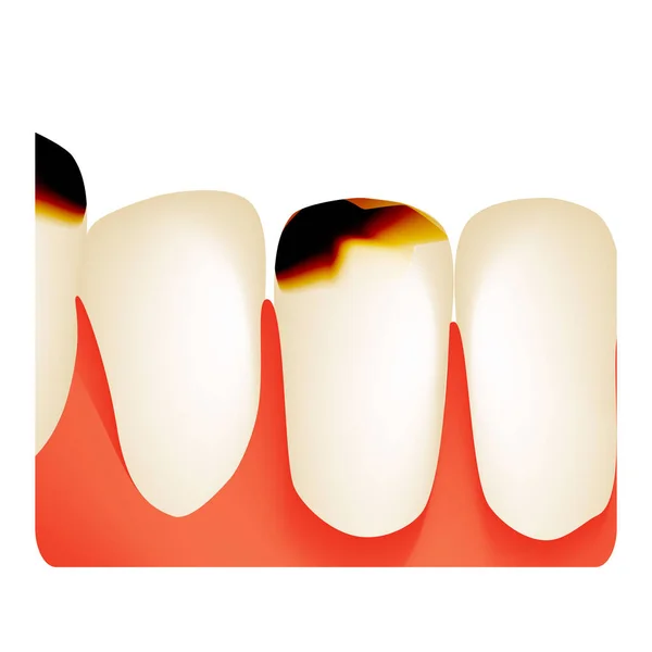 Próchnica dentystyczna. próchnica zębów. Infografika próchnicy. Ilustracja wektora na pojedynczym tle. — Wektor stockowy