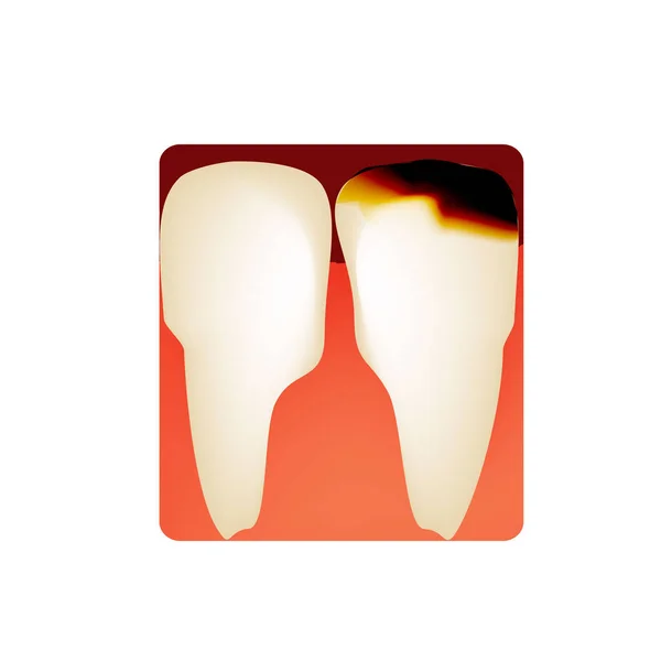 Zubní kaz. zubní kaz. Caries infographics. Vektorová ilustrace na izolovaném pozadí. — Stockový vektor
