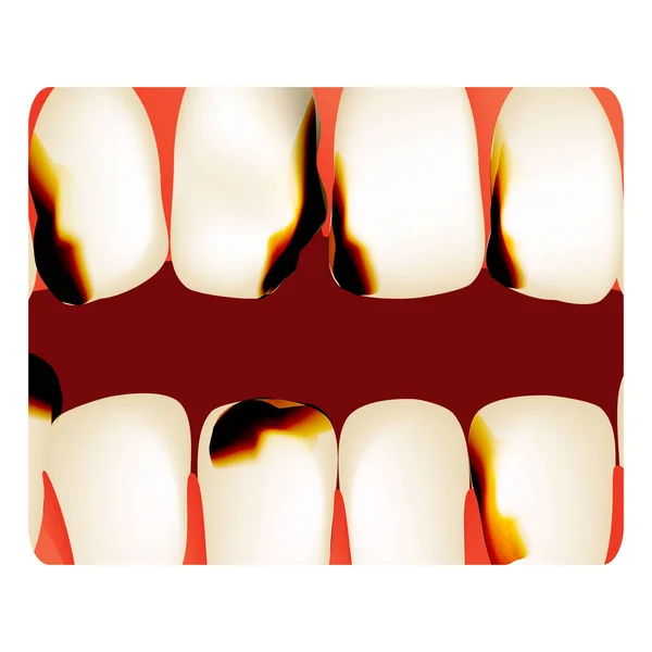 Dentin Decayストックベクター ロイヤリティフリーdentin Decayイラスト ページ 3 Depositphotos Dentin Decayストックベクター ロイヤリティフリーdentin Decayイラスト ページ 3 Depositphotos