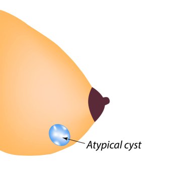 Tipik bir göğüs kisti. Meme bezi. Dünya Göğüs Kanseri Günü. İzole edilmiş arkaplanda vektör illüstrasyonu
