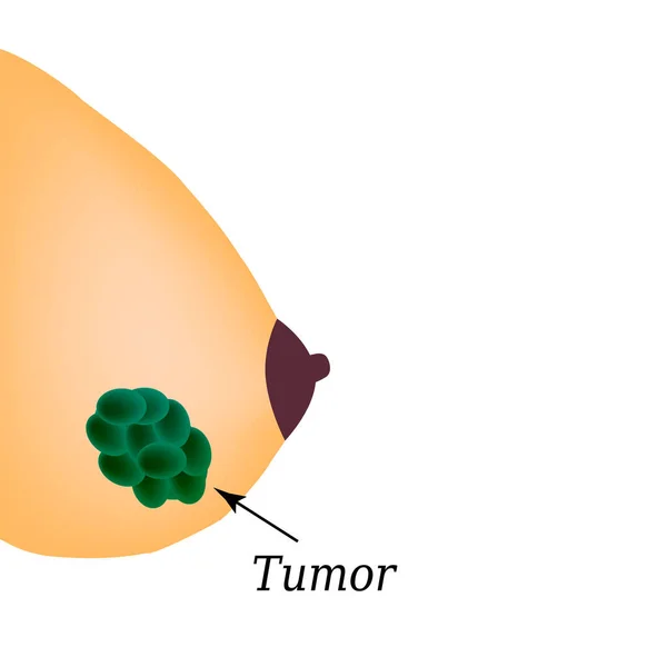 Tumor en la glándula mamaria. Día Mundial del Cáncer de Mama. Ilustración vectorial sobre fondo aislado — Vector de stock