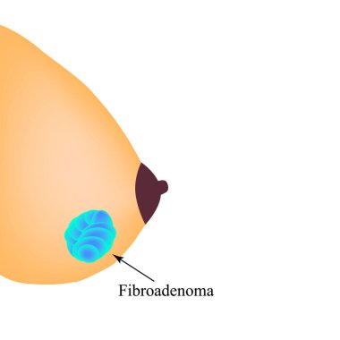 Meme bezinde fibroenom var. Dünya Göğüs Kanseri Günü. İzole edilmiş arkaplanda vektör illüstrasyonu